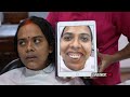 Orthognathic Upper jaw Surgery in India - Full Surgery - Dr. Sunil Richardson