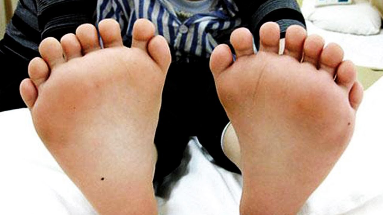 10 People Born with Extra Body Parts YouTube