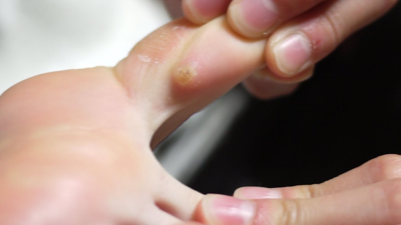 ウイルス性イボ イボ治療 簡単完治 Viral Warts Wart Treatment Tratamiento De Verrugas Youtube ウイルス性イボ イボ治療 簡単完治 Viral Warts Wart Treatment Tratamiento De Verrugas Youtube