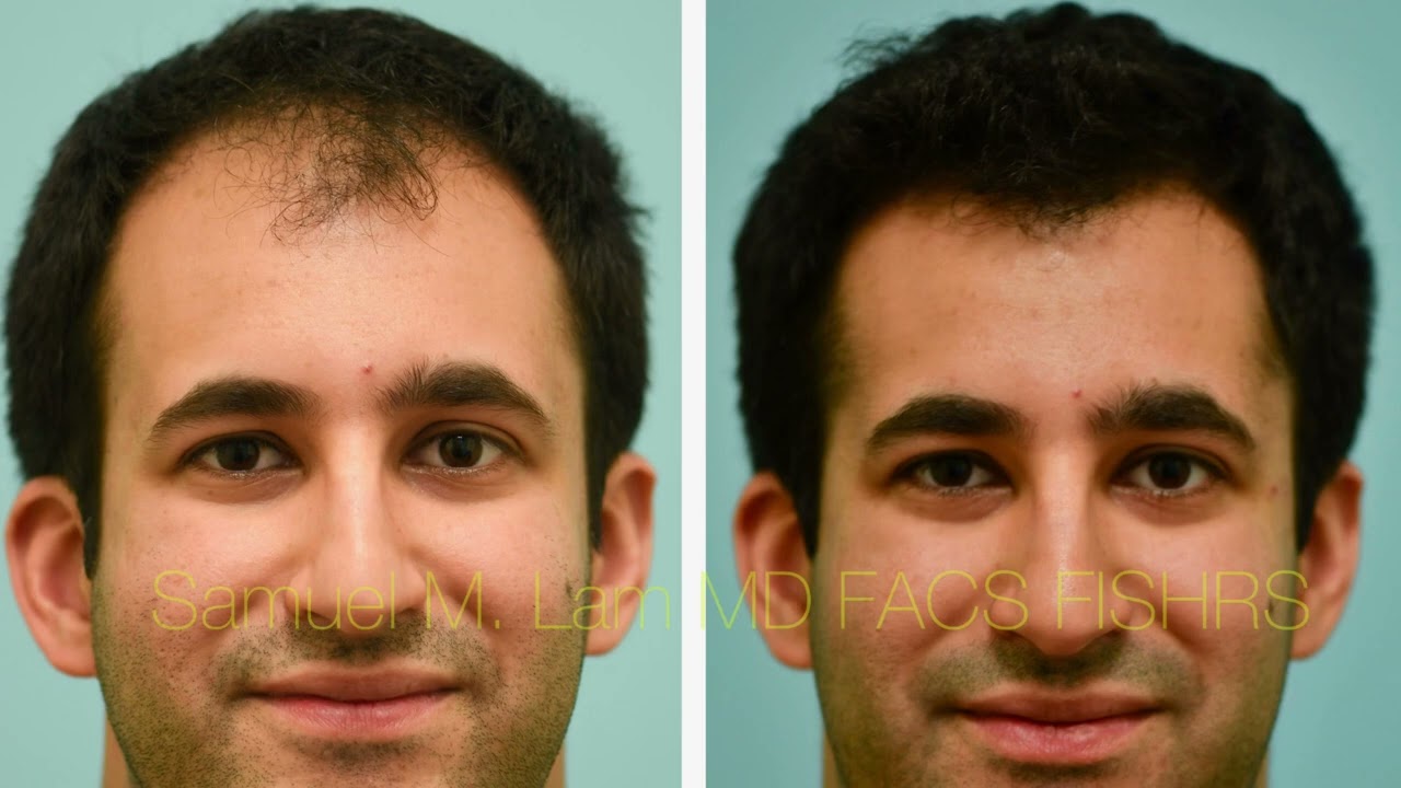 FUE Hair Transplant Testimonial with Photos in Dallas with Dr. Sam Lam