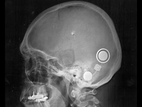 Bone bridge English Captions - YouTube