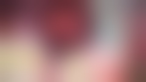 Misloaded IOL in a Floppy Iris Cataract Surgery Case