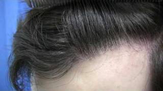 Doctor Hasson Hair Transplant - 2414 Grafts - 1 Session