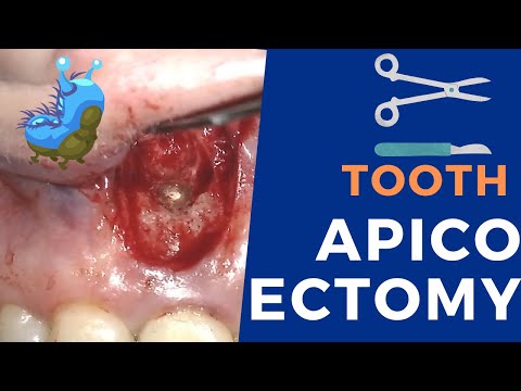 Video: Kas ir apico zobu ķirurģija?