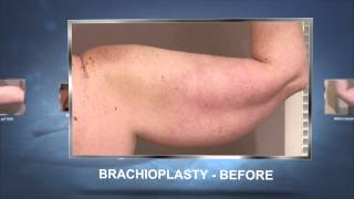Houston Arm Lift Plastic Surgery: Brachioplasty