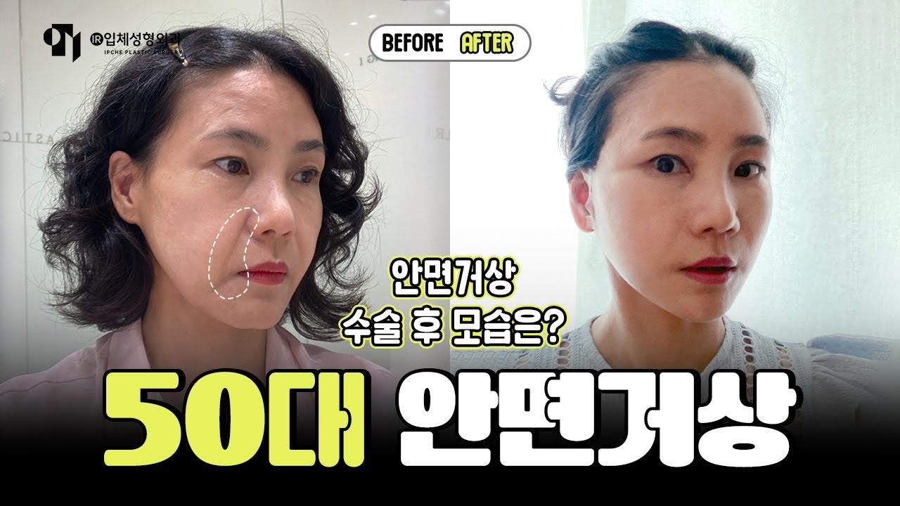 안면거상+목거상 수술 후 2주차 후기 (통증, 감각, 붓기, 회복과정)