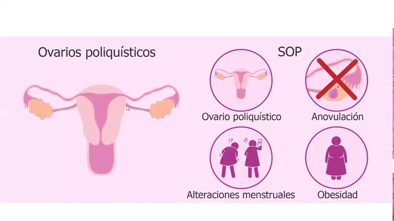 Sintomas del ovario poliquistico