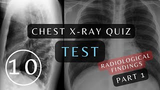 Can You Pass This Quiz Questions And Answers 10 Essential Chest X-Rays