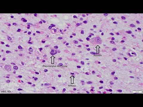 Video: RNA-redigeringsbaserad Klassificering Av Diffusa Gliomas: Förutsäga Isocitratdehydrogenasmutation Och Kromosom 1p / 19q Kodeletion