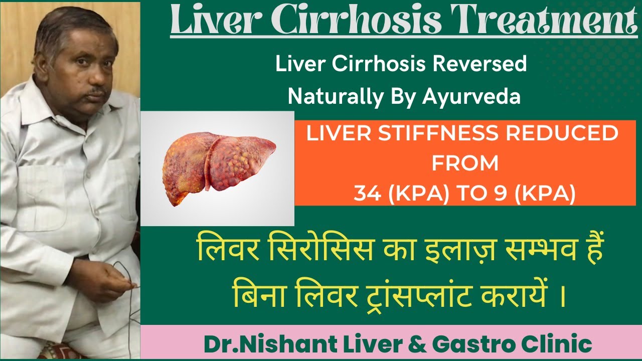 Liver Cirrhosis Reversed by Ayurveda Part 2 लाइलाज नहीं हैं लिवर