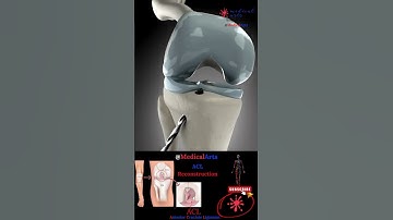 ACL Rupture 🦴 Reconstruction ∞ Medical Arts 🦴 Surgical 3D Animation