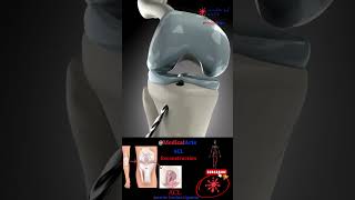 Acl Rupture 🦴 Reconstruction ∞ Medical Arts 🦴 Surgical 3D Animation