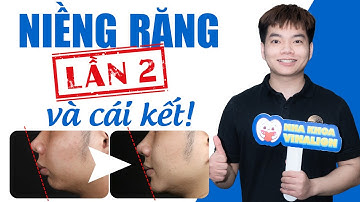 Niềng Răng Lần Hai Và Cái Kết Bất Ngờ | Nam Bùi Vinalign