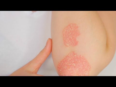 Vidéo: Conseils Pour Gérer Le Psoriasis Dans Le Froid