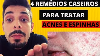 4 Remédios Caseiros Para Tratar Acnes E Espinhas