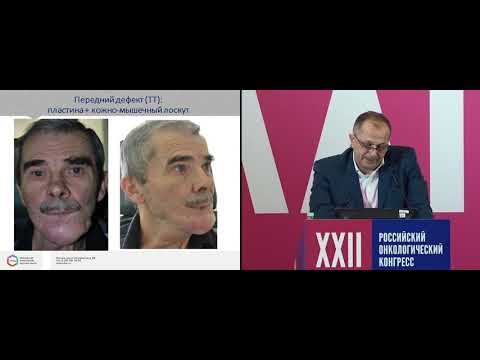 Видео: Функциональные результаты при раннем (T1 / T2) супраглоттическом раке: систематический обзор