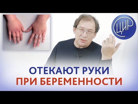 Отёк рук при беременности на 36 неделе. Затекают руки во время сна - это норма или пора к врачу?