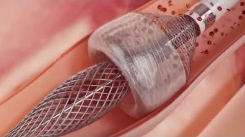 How This Device Safely Removes Blood Clots | Medico Asmr