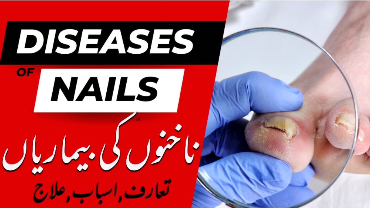 Diseases of Nails brittle Nails disorders ) nakhun ki
