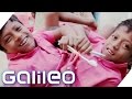 Siamesische Zwillinge: Das einzigartige Zwillingsduo aus Indien | Galileo | ProSieben