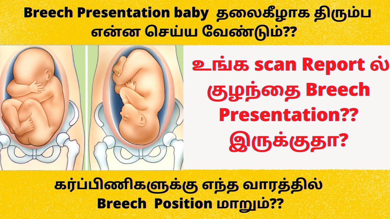 breech presentation tamil