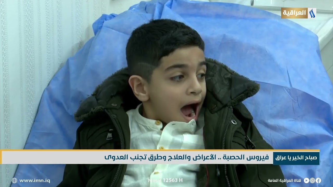 فيروس الحصبة .. الأعراض والعلاج وطرق تجنب العدوى