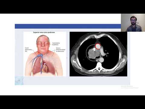 ქეისის გარჩევა #2