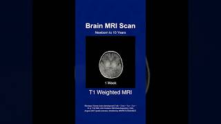 Watch Wrinkles Develop In Brain Mri Scans T1 Weighted