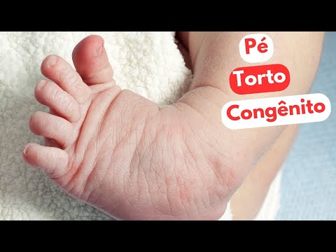 Vídeo: Pé Torto Em Crianças - Tratamento, Massagem, Sinais De Pé Torto Congênito