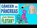 El cáncer de páncreas ¿hace flotar las heces?