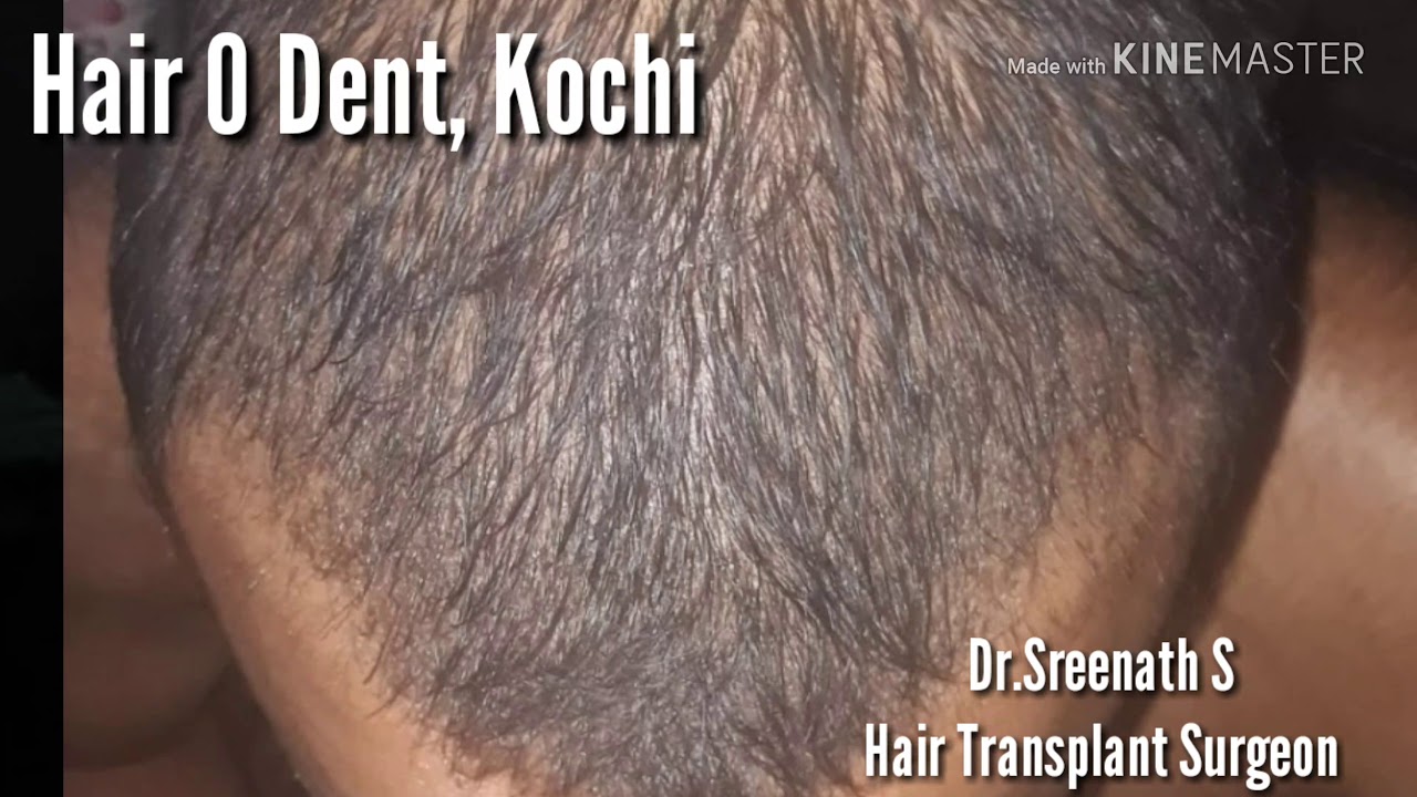Before and After Results of FUE Hair Transplant of 3000 grafts in