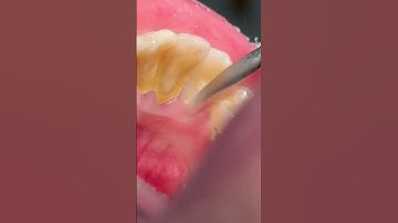 Scaling & cleaning tartar #teeth #tooth #satisfying