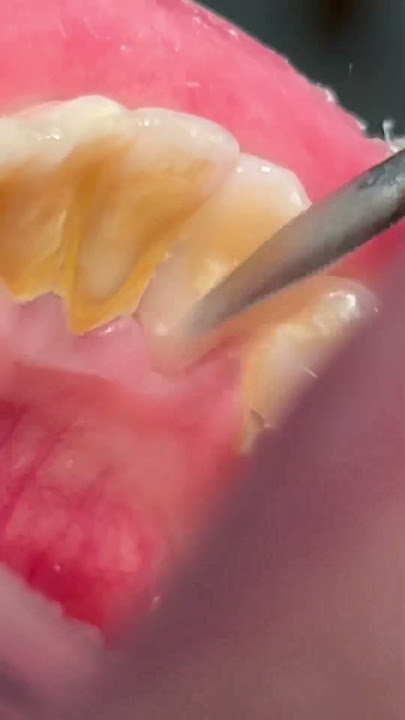 Scaling & cleaning tartar #teeth #tooth #satisfying