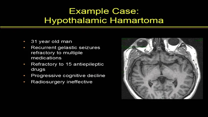 Nathan Fountain - Focused Ultrasound for Subcortic...