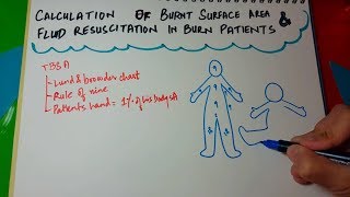 Burns surface area calculation and fluid resuscitation