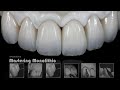 Mastering Monolithic Zirconia IN ENGLISH