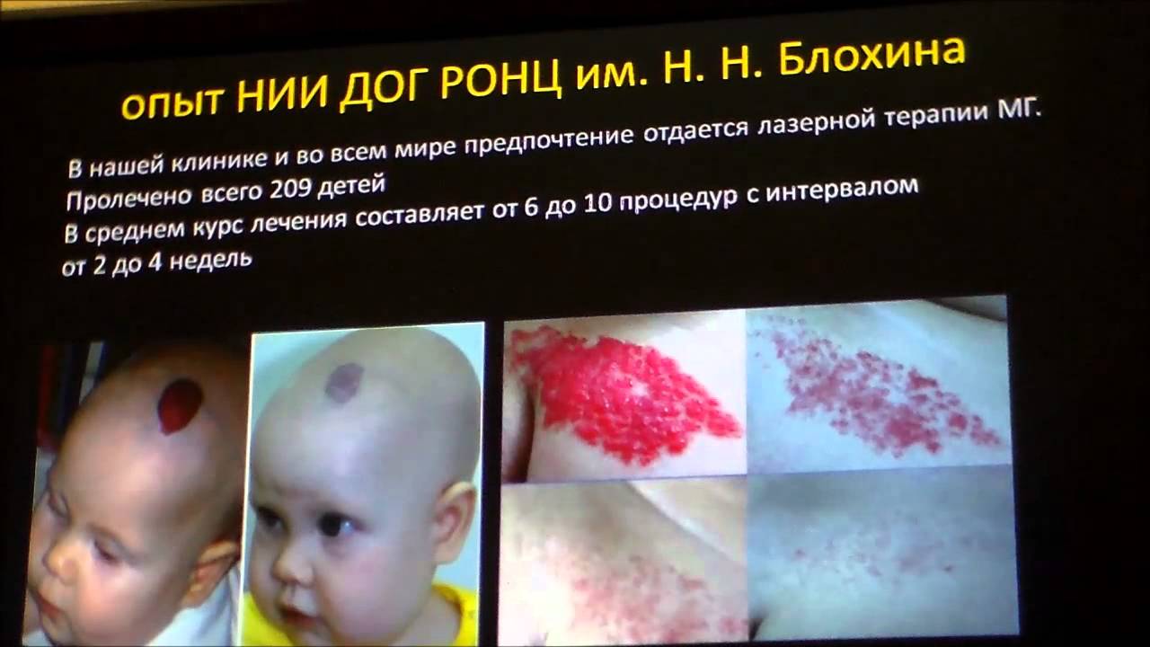 Младенческая гемангиома Современное состояние проблемы - YouTube