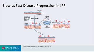 Treating Acute Exacerbations: Disease Progression - Interstitial Lung Disease