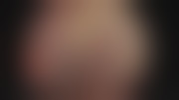 Module 07: Orbital and optic nerve decompression