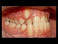 Orthodontic Tx for SK Class III with Anterior cross bite & Sever Crowding of upper arch