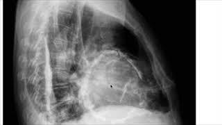 Details Cardiac temponade Vs Constrictive Pericarditis Vs Restrictive Cardiomyopathy Update