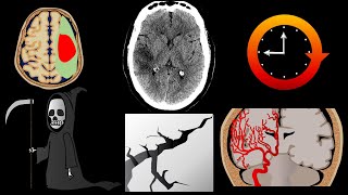 Famous How to read a HEAD CT in ACUTE STROKE Net Worth