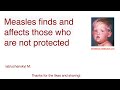 Measles finds and affects those who are not protected