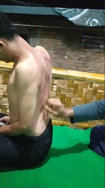 Akibat byk begadang,jadi di kerikin badan smpe pada merah|#short#