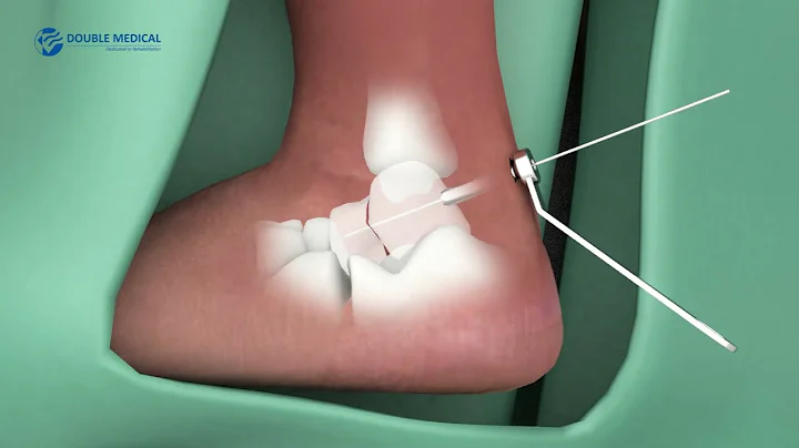 Headless Cannulated Screw