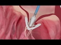 PASCAL repair system features - Implantation of the system in the mitral valve | Animation