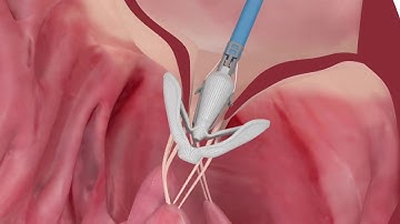 PASCAL repair system features - Implantation of the system in the mitral valve | Animation