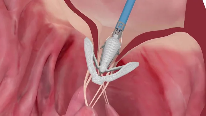 PASCAL repair system features - Implantation of th...