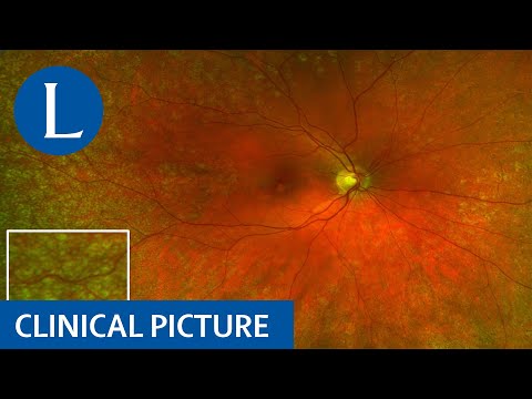 Clinical Picture | Drusen in the retina