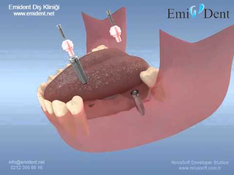 implant üstü porselen128 xvid